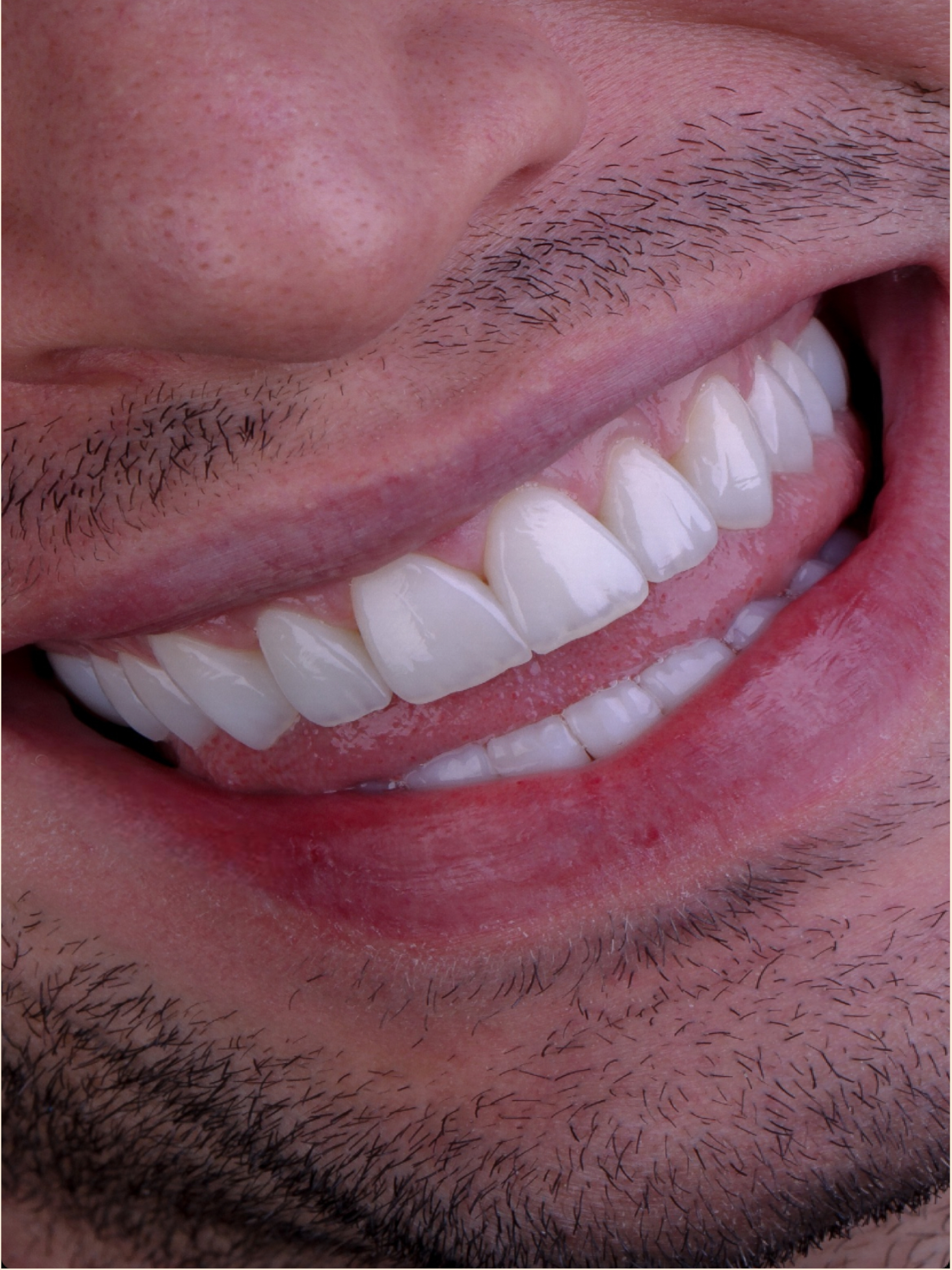 Imagem do resultado do procedimento de facetas